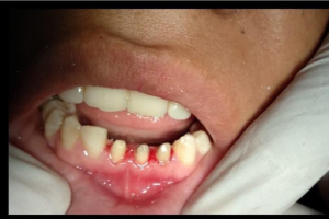 Before Treatment