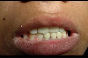 After Treatment